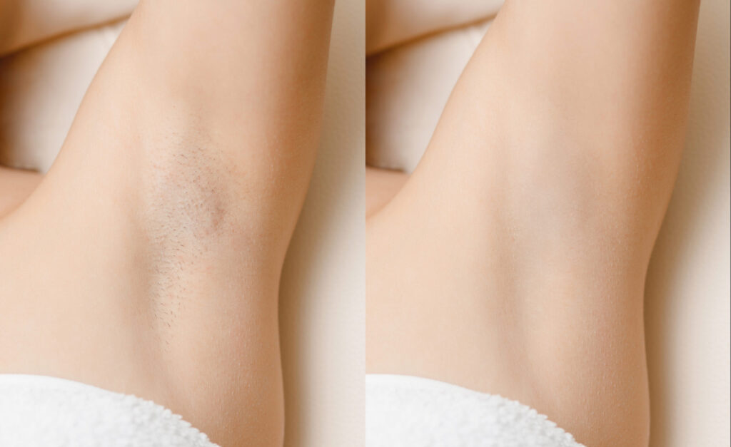 Affordable IPL Hair Removal Treatments