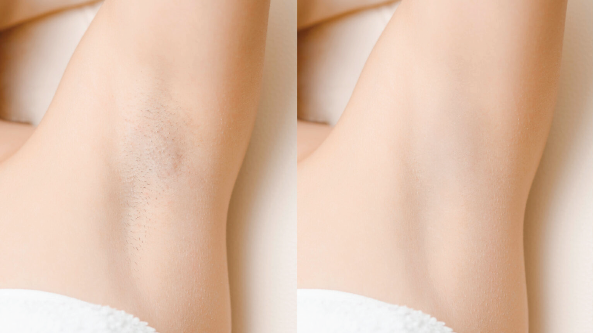 Affordable Laser IPL Hair Removal Canada Brandon MB